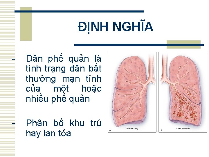 ĐỊNH NGHĨA - Dãn phế quản là tình trạng dãn bất thường mạn tính