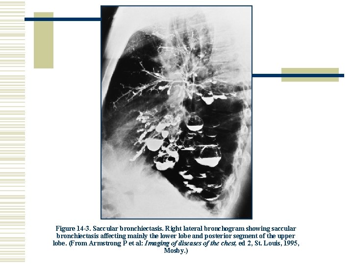 Figure 14 -3. Saccular bronchiectasis. Right lateral bronchogram showing saccular bronchiectasis affecting mainly the
