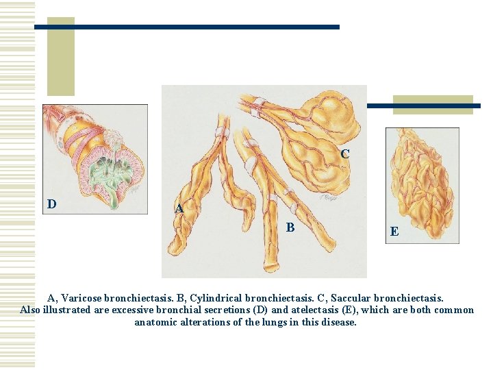 C D A B E A, Varicose bronchiectasis. B, Cylindrical bronchiectasis. C, Saccular bronchiectasis.