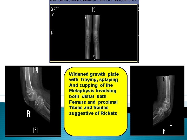 Widened growth plate with fraying, splaying And cupping of the Metaphysis Involving both distal