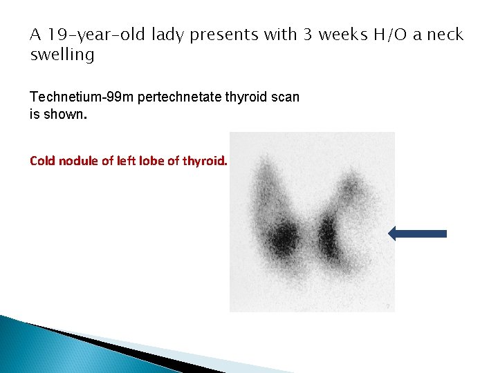 A 19 -year-old lady presents with 3 weeks H/O a neck swelling Technetium-99 m