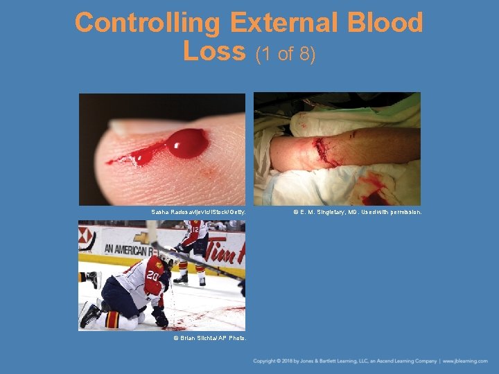 Controlling External Blood Loss (1 of 8) Sasha Radosavljevic/i. Stock/Getty. © Brian Slichta/ AP