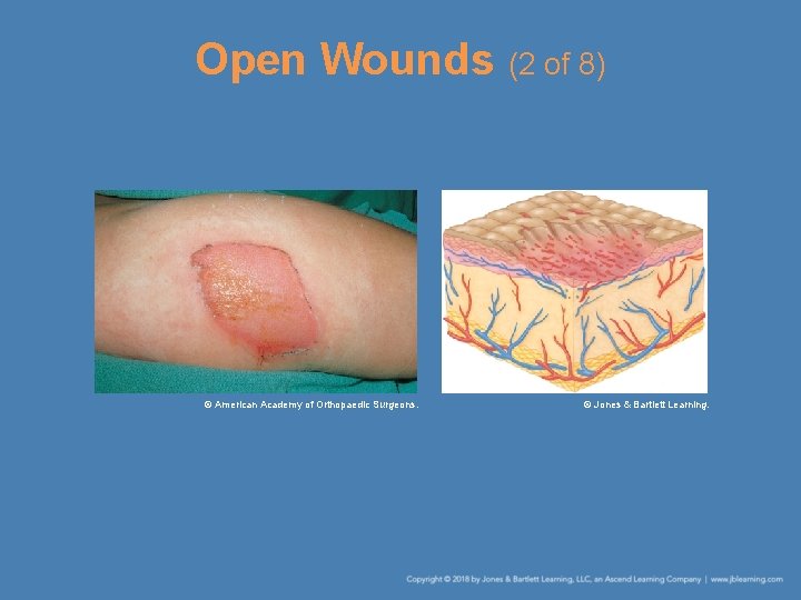 Open Wounds (2 of 8) © American Academy of Orthopaedic Surgeons. © Jones &