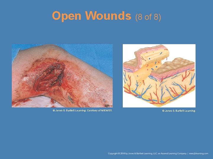 Open Wounds (8 of 8) © Jones & Bartlett Learning. Courtesy of MIEMSS. ©