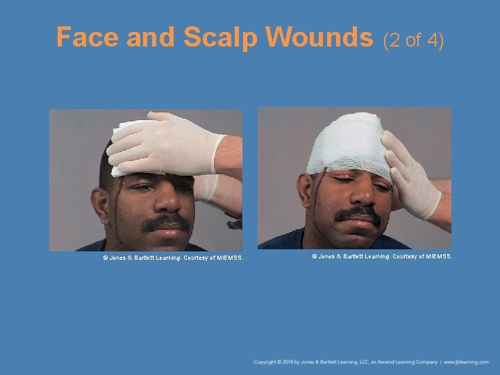 Face and Scalp Wounds (2 of 4) © Jones & Bartlett Learning. Courtesy of