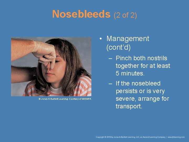 Nosebleeds (2 of 2) • Management (cont’d) – Pinch both nostrils together for at
