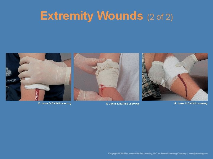 Extremity Wounds (2 of 2) © Jones & Bartlett Learning. 