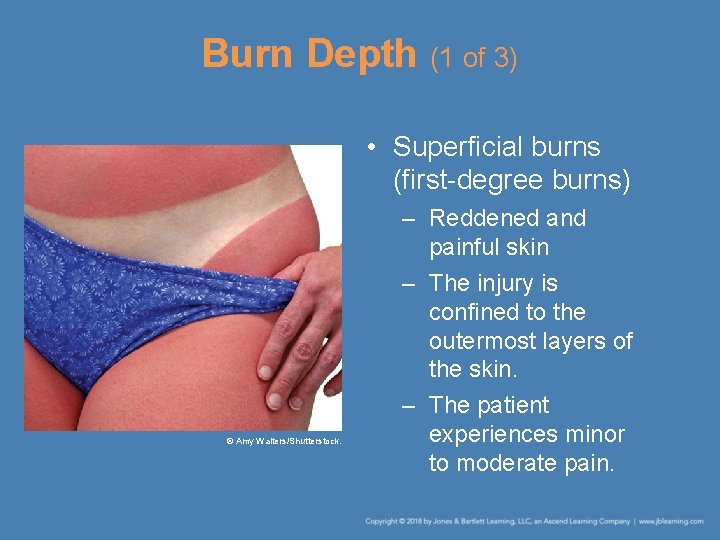 Burn Depth (1 of 3) • Superficial burns (first-degree burns) © Amy Walters/Shutterstock. –