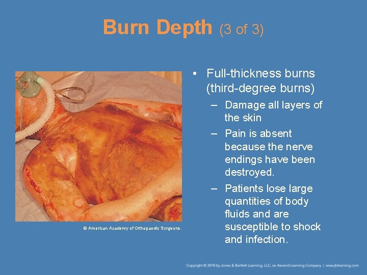 Burn Depth (3 of 3) • Full-thickness burns (third-degree burns) © American Academy of