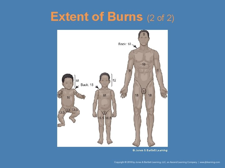 Extent of Burns (2 of 2) © Jones & Bartlett Learning. 