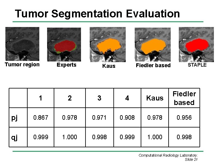 Tumor Segmentation Evaluation Tumor region Experts Fiedler based Kaus STAPLE 1 2 3 4