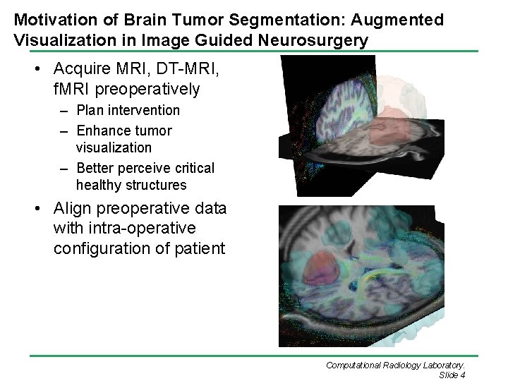 Motivation of Brain Tumor Segmentation: Augmented Visualization in Image Guided Neurosurgery • Acquire MRI,