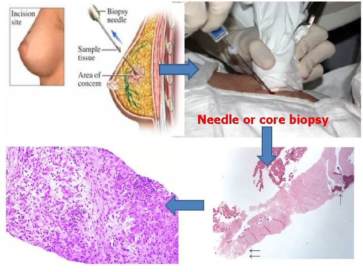 Needle or core biopsy 