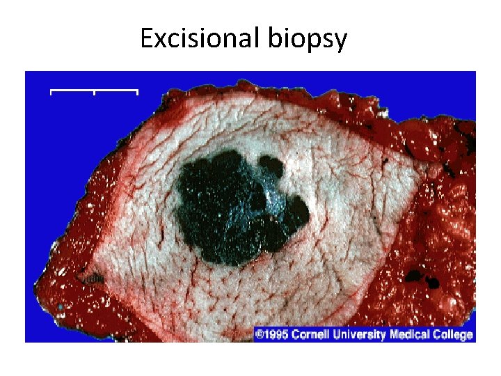 Excisional biopsy 