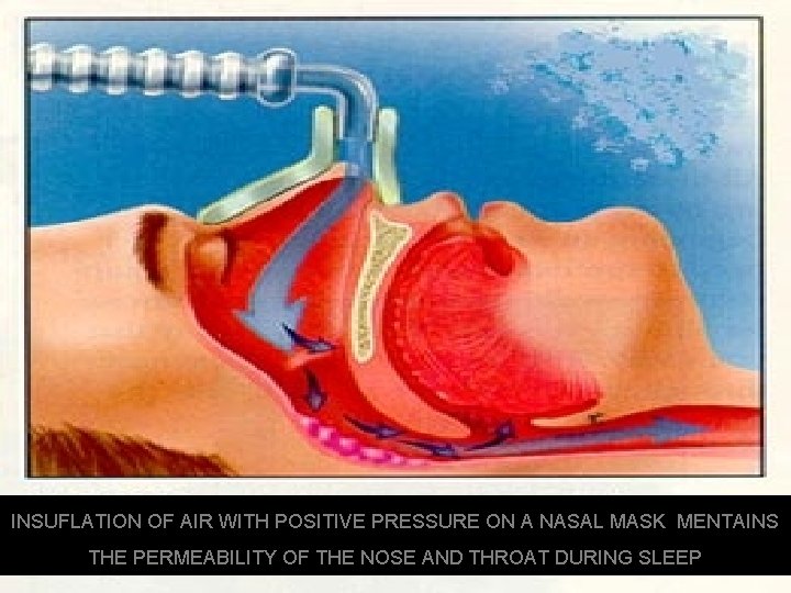 INSUFLATION OF AIR WITH POSITIVE PRESSURE ON A NASAL MASK MENTAINS THE PERMEABILITY OF