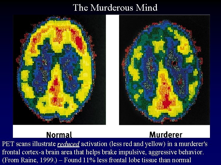 The Murderous Mind PET scans illustrate reduced activation (less red and yellow) in a