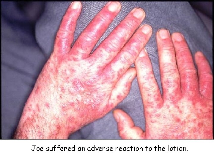 Joe suffered an adverse reaction to the lotion. 