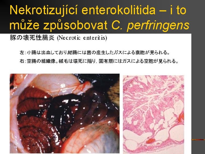Nekrotizující enterokolitida – i to může způsobovat C. perfringens 