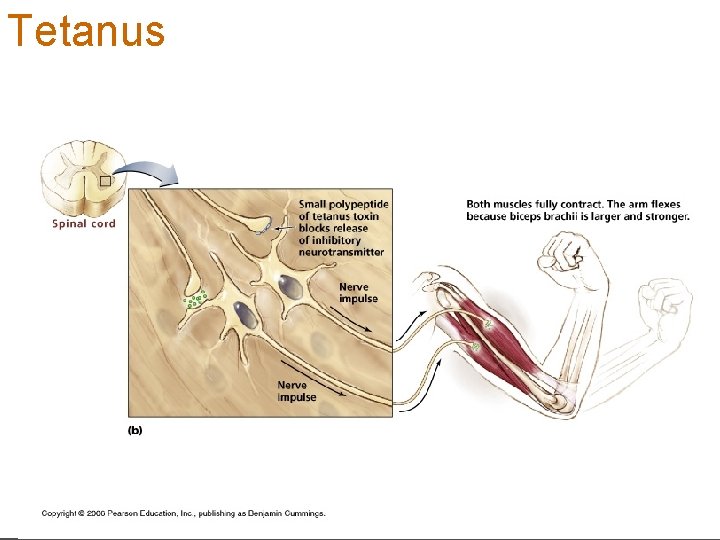 Tetanus 