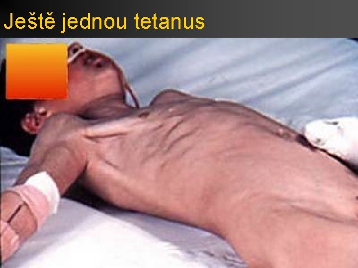 Ještě jednou tetanus 