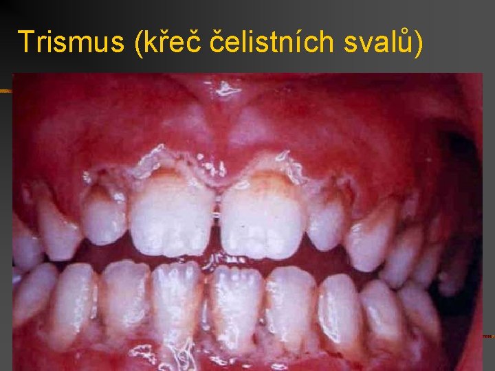 Trismus (křeč čelistních svalů) 