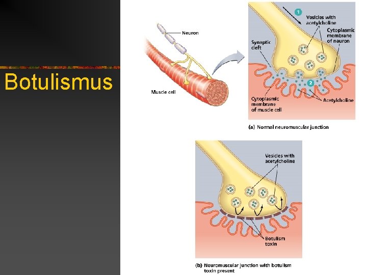 Botulismus 