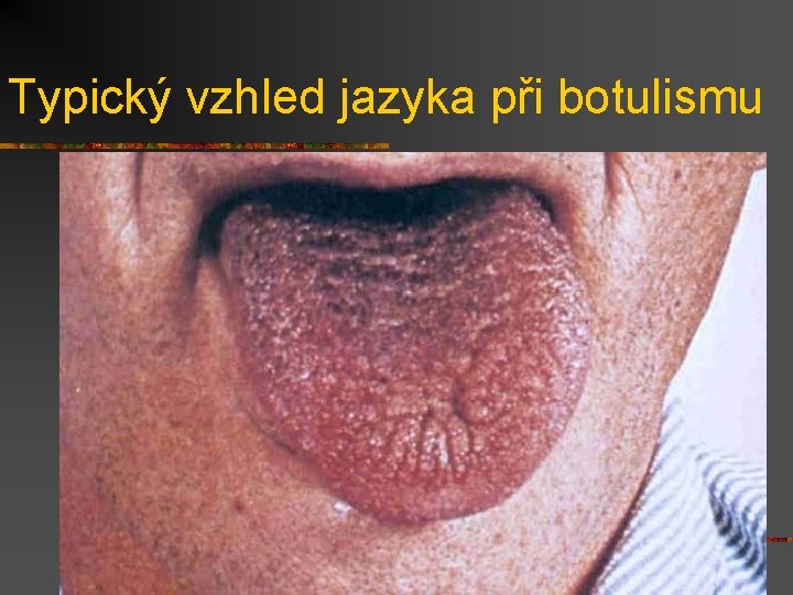 Typický vzhled jazyka při botulismu 