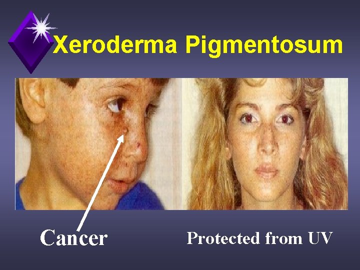 Xeroderma Pigmentosum Cancer Protected from UV 