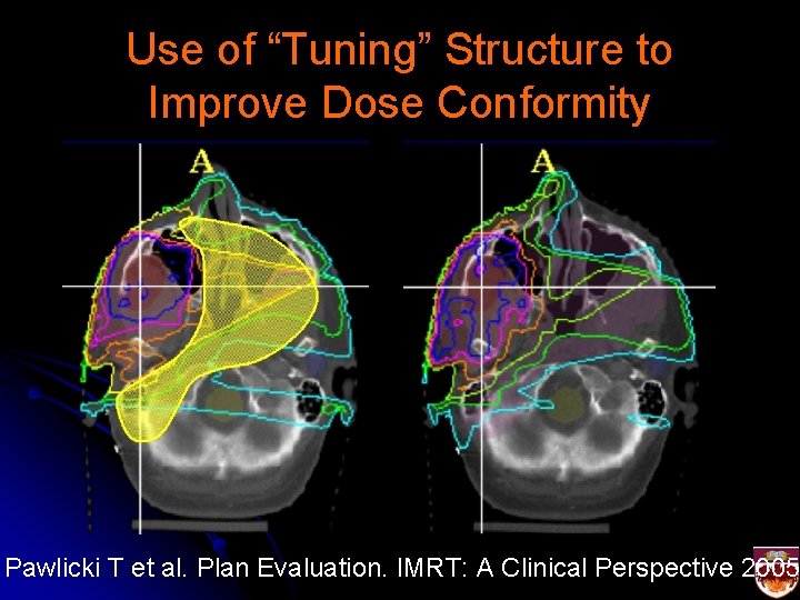 Use of “Tuning” Structure to Improve Dose Conformity Pawlicki T et al. Plan Evaluation.