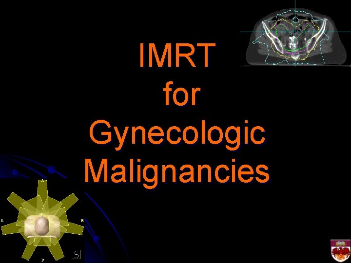 IMRT for Gynecologic Malignancies 