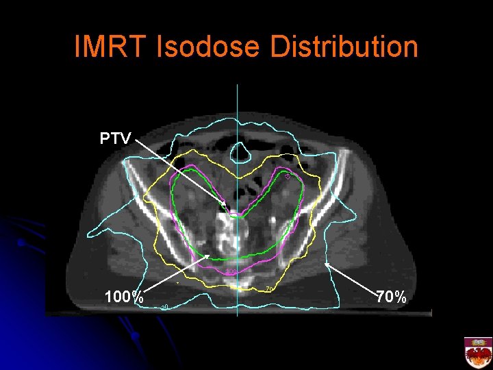 IMRT Isodose Distribution PTV 100% 70% 