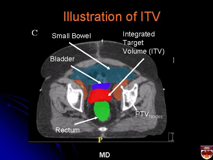 Illustration of ITV Integrated Target Volume (ITV) Small Bowel Bladder PTVNodes Rectum MD 