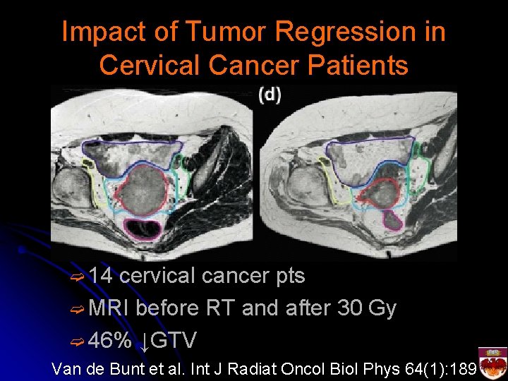 Impact of Tumor Regression in Cervical Cancer Patients ➫ 14 cervical cancer pts ➫