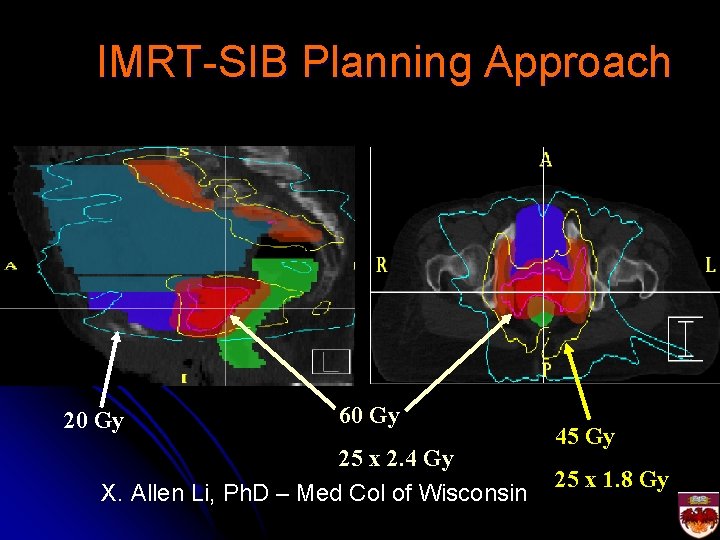 IMRT-SIB Planning Approach 20 Gy 60 Gy 25 x 2. 4 Gy X. Allen