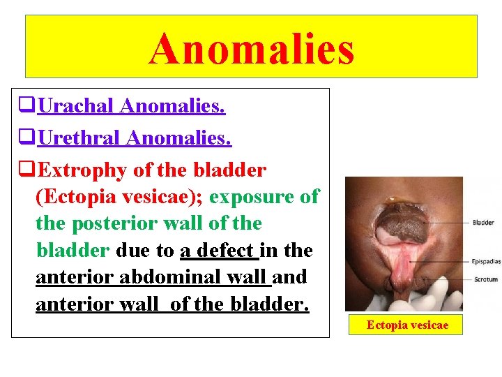 Anomalies q. Urachal Anomalies. q. Urethral Anomalies. q. Extrophy of the bladder (Ectopia vesicae);