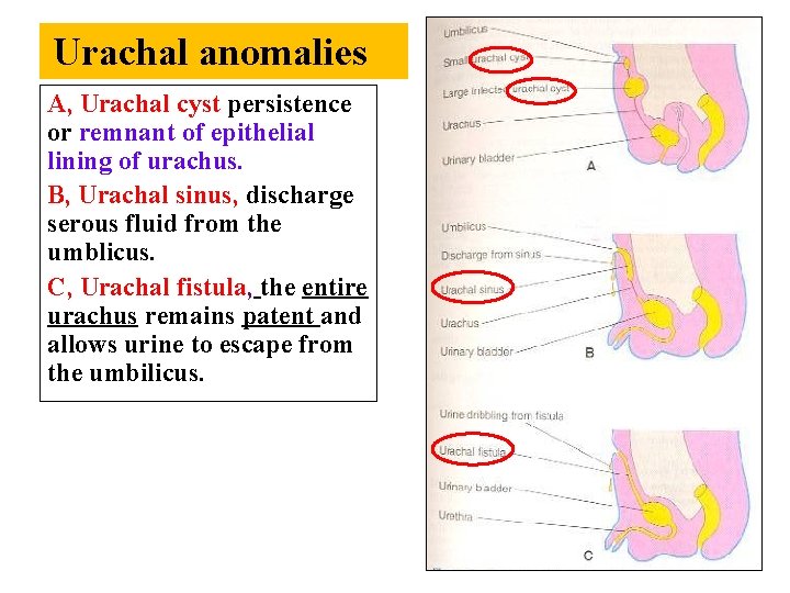 Urachal anomalies A, Urachal cyst persistence or remnant of epithelial lining of urachus. B,