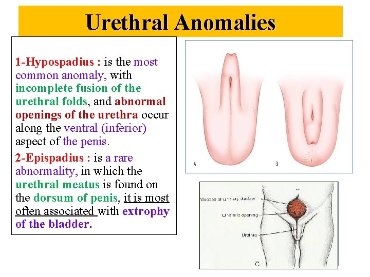 Urethral Anomalies 1 -Hypospadius : is the most common anomaly, with incomplete fusion of