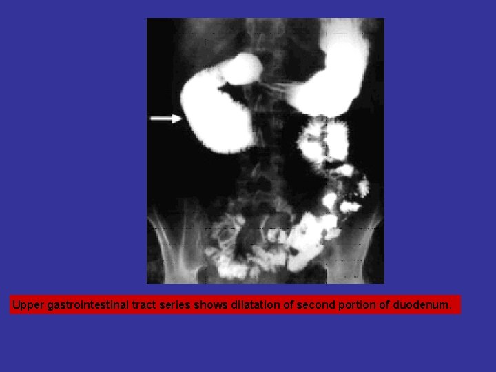 Upper gastrointestinal tract series shows dilatation of second portion of duodenum. 