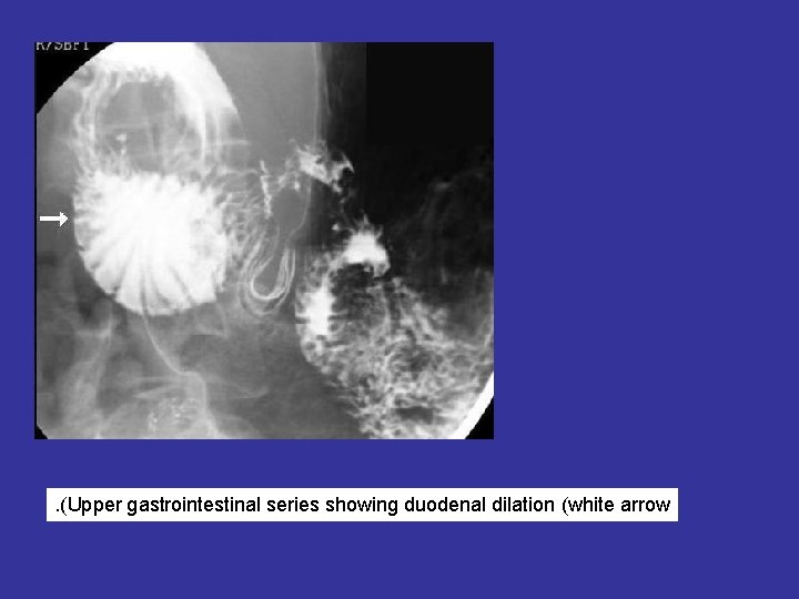 . (Upper gastrointestinal series showing duodenal dilation (white arrow 