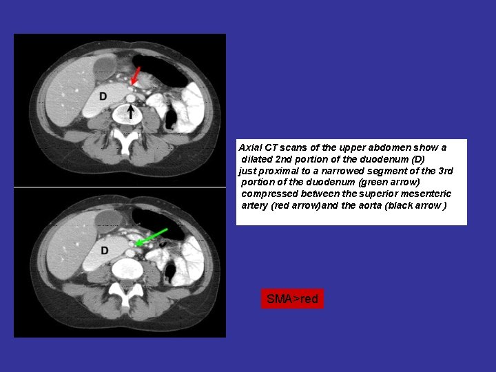 Axial CT scans of the upper abdomen show a dilated 2 nd portion of