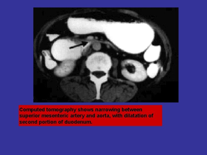 Computed tomography shows narrowing between superior mesenteric artery and aorta, with dilatation of second