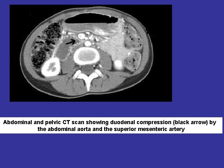 Abdominal and pelvic CT scan showing duodenal compression (black arrow) by the abdominal aorta