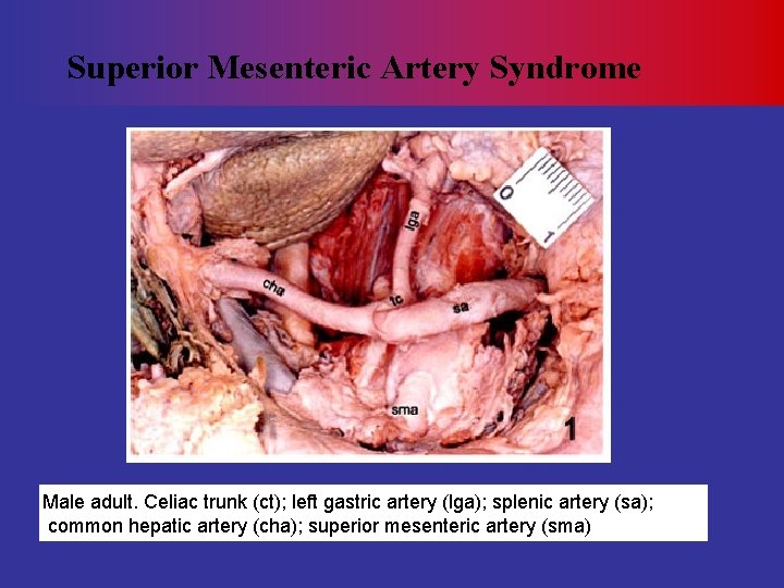 Superior Mesenteric Artery Syndrome Male adult. Celiac trunk (ct); left gastric artery (lga); splenic