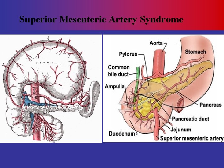 Superior Mesenteric Artery Syndrome 