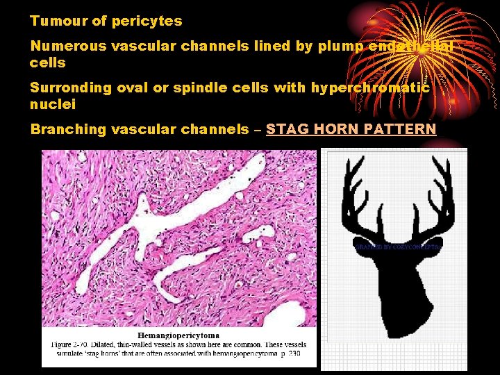Tumour of pericytes Numerous vascular channels lined by plump endothelial cells Surronding oval or