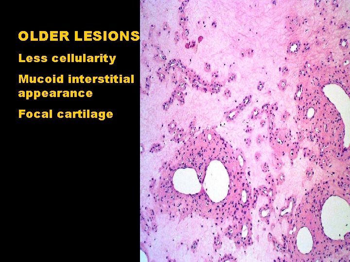 OLDER LESIONS Less cellularity Mucoid interstitial appearance Focal cartilage 