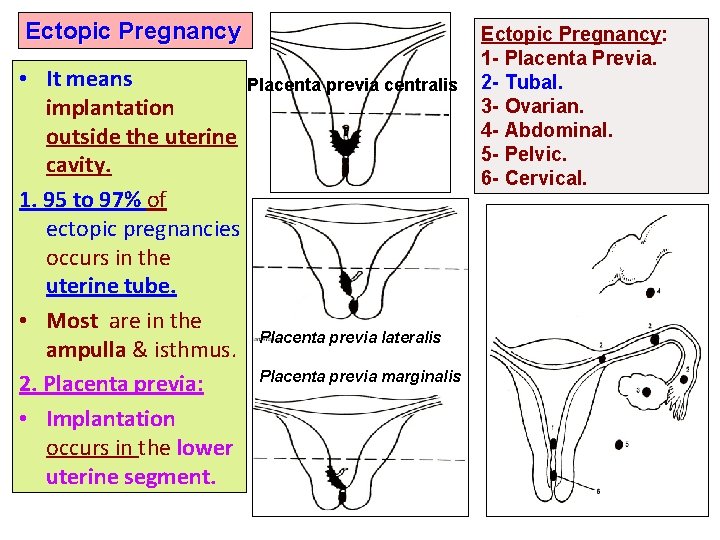 Ectopic Pregnancy • It means Placenta previa centralis implantation outside the uterine cavity. 1.