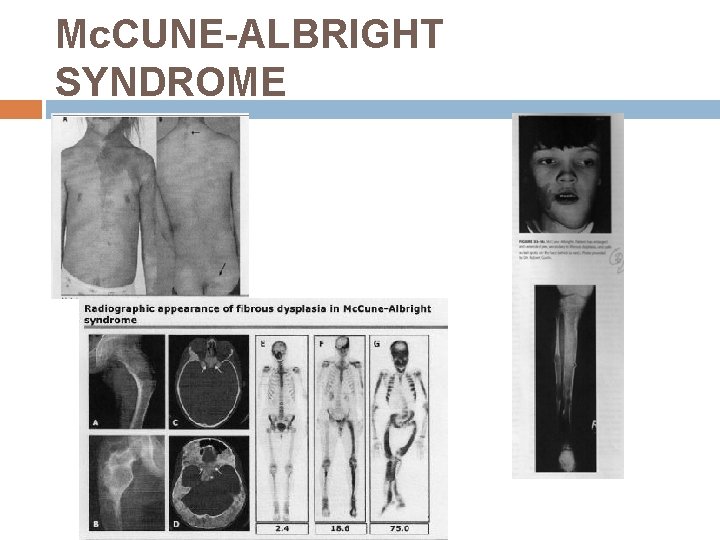Mc. CUNE-ALBRIGHT SYNDROME 