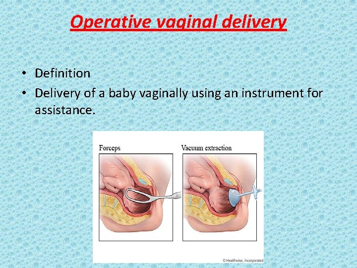 Operative vaginal delivery • Definition • Delivery of a baby vaginally using an instrument