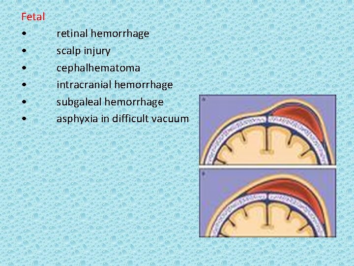 Fetal • • • retinal hemorrhage scalp injury cephalhematoma intracranial hemorrhage subgaleal hemorrhage asphyxia